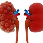 Uzmanı uyardı! Kronik kabızlık kasık fıtığı riskini artırıyor!