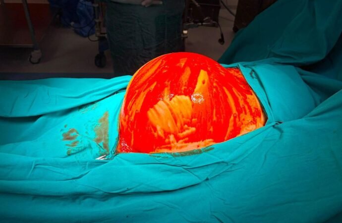 74 Yaşındaki Hastada 6,5 Kilogramlık Tümör Tespit Edildi